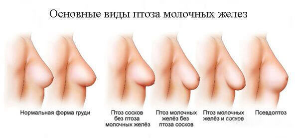 Птоз (обвисание) молочных желез