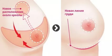 Цены на операцию по уменьшению груди